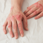 ¿Cómo afecta la dermatitis atópica a la calidad de vida de una persona?