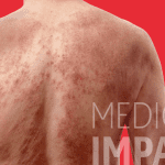 Hablemos de la dermatitis atópica: Una enfermedad crónica que hace que la piel se irrite e inflame